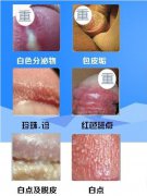 龟头炎图片-南阳治疗
